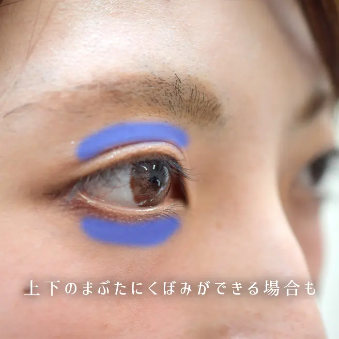 副作用で失明するって本当 ビマトプロスト使用による危険性を解説します 個人輸入代行 通販ラククル