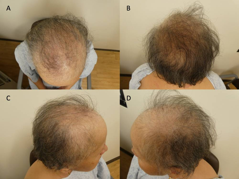 乳がん患者のミノキシジルによる治療後頭皮