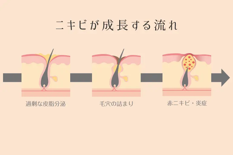 アルダクトン スピロノラクトン がニキビに効かない 治らない時に 個人輸入代行 通販ラククル