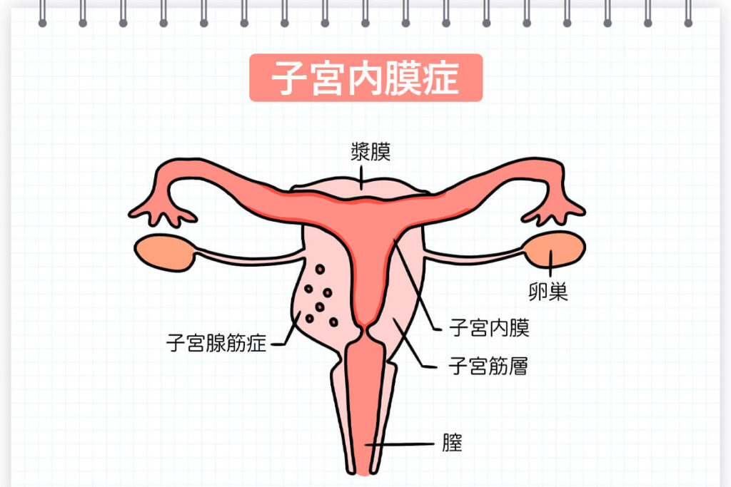 子宮内膜症